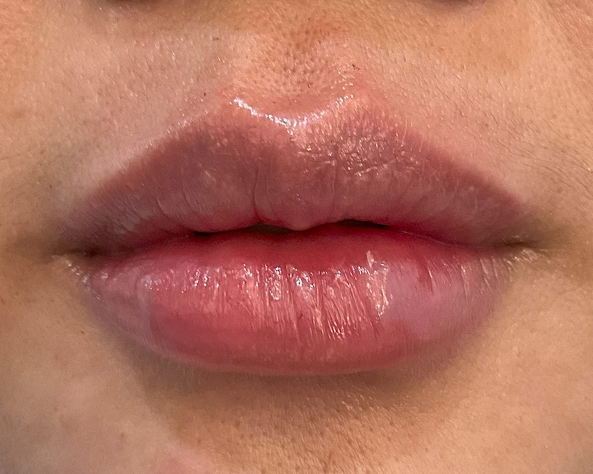 After treatment
