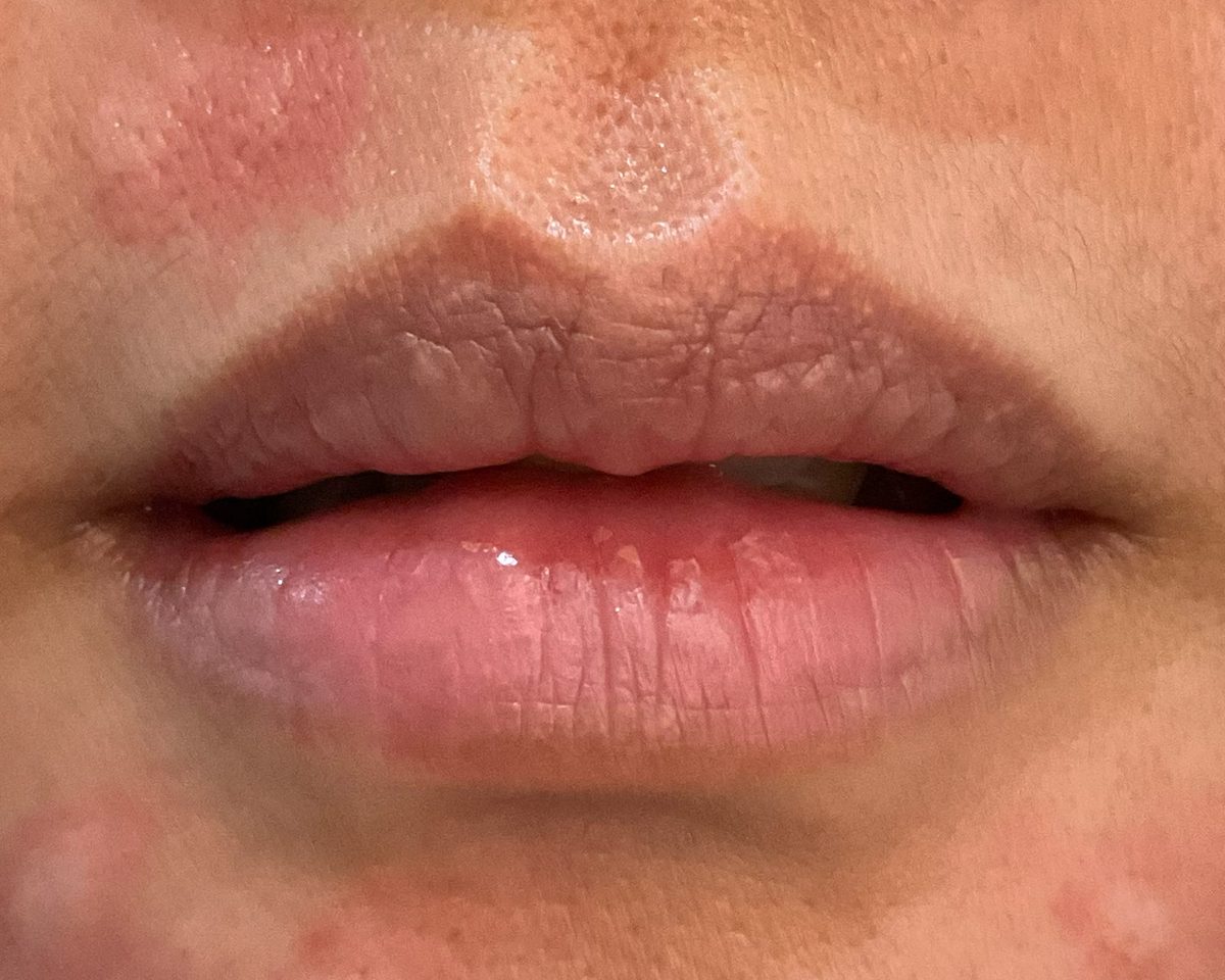 Before treatment